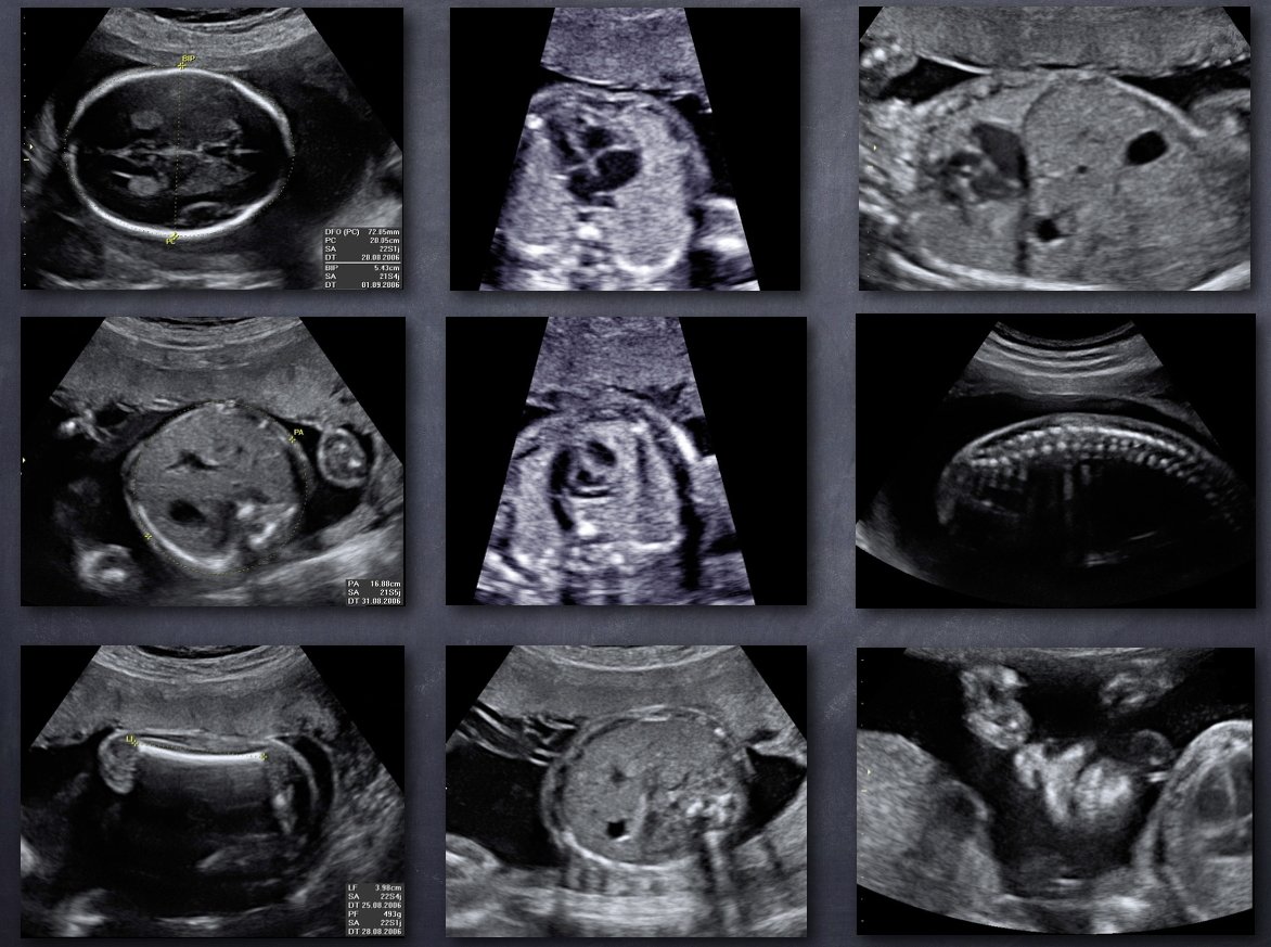 L'échographie au cours de la grossesse